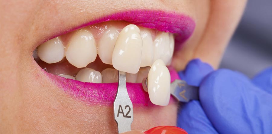 Faccette dentali